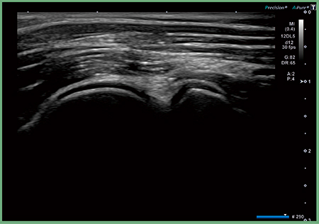 図3　高周波プローブによる腕橈関節の描出