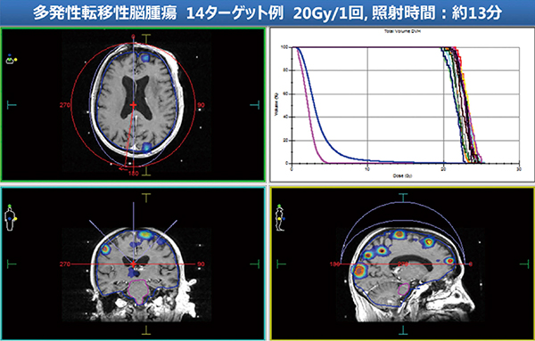図1　多発性転移性脳腫瘍に対するHDRSの線量分布