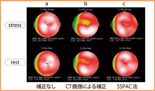 図7　SPECT/CT装置のCT画像を使った減弱補正（b）とSSPAC法による減弱補正（c）の比較 （データご提供：金沢大学様）