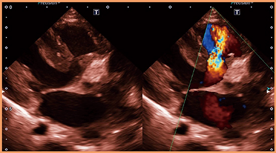 図2　PST-65BTによる小児心臓のCDI像 （画像ご提供：長野県立こども病院循環器センター・安河内　聰先生）