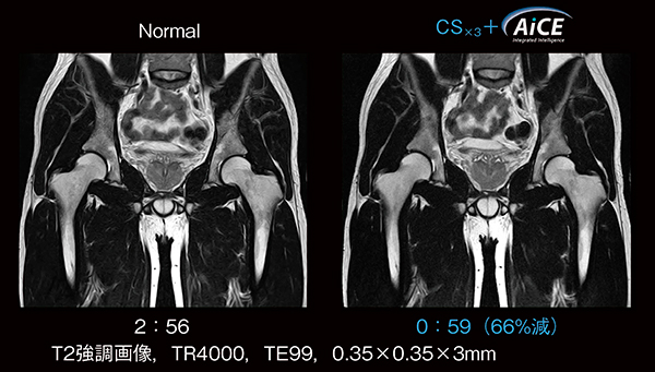 図4　Vantage Orianにて撮像した骨盤部のT2強調画像のCSとAiCE適応例