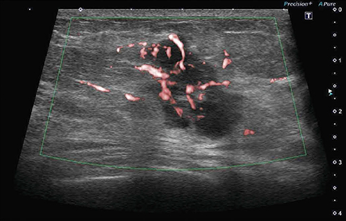 図2　乳腺腫瘍のcSMI画像 （画像ご提供：高松平和病院・何森亜由美先生）