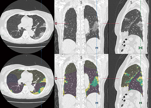図1　新型コロナウイルス肺炎のCT画像および肺テクスチャ解析結果 上段：原画像 下段：解析結果