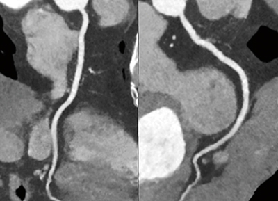 図3　Spectral Volume Scanで撮影した1volume冠動脈CT画像：高体重症例（104kg，BMI 30.4）