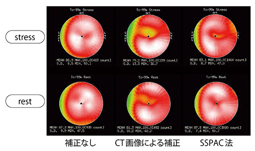 図5　SPECT/CT装置のCT画像を使った減弱補正とSSPAC法による減弱補正の比較 （データご提供：金沢大学様）