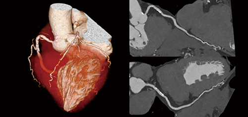 図1　Spectral Volume Scanで撮影した冠動脈CT画像 （画像ご提供：藤田医科大学病院様）