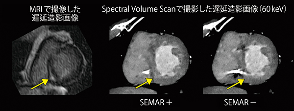 図2　Spectral Volume Scanで撮影した遅延造影画像（SEMAR併用例） （画像ご提供：杏林大学病院様）