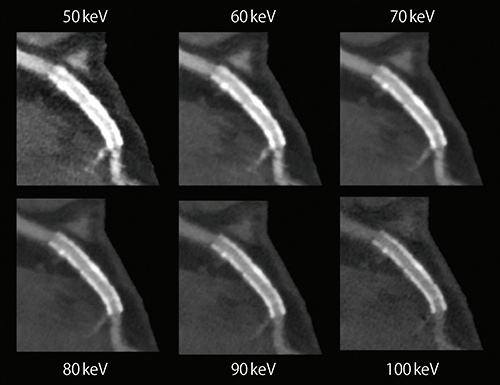 図3　仮想単色X線画像例 （画像ご提供：華岡青洲記念病院様）