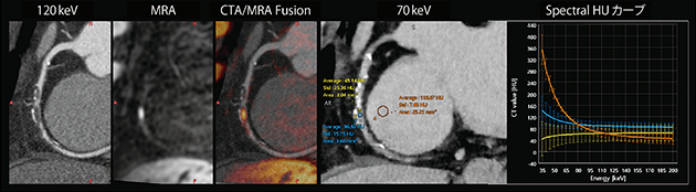 図4　スペクトラルカーブ活用例 single energy scan（120keV）で冠動脈の主要血管にプラークが散在している様子が確認できる。Spectral HUカーブにおいて，青色と黄色はプラーク，橙色は心筋を示している。低keV側において，青色はCT値が上昇し線維性プラークが疑われ，黄色はCT値が下降し脂質性プラークを疑われた。MRAのhigh intensity plaqueの所見とも一致している。 （画像ご提供：華岡青洲記念病院様）