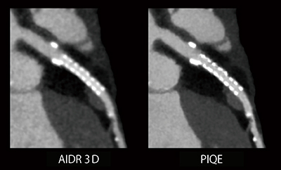 図5　AIDR 3D＊とPIQEで再構成した比較画像（2.5mm径ステント症例） ＊Adaptive Iterative Dose Reduction 3D：AIDR 3D （画像ご提供：華岡青洲記念病院様）