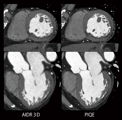 図6　AIDR 3DとPIQEで再構成した比較画像（心筋梗塞症例） （画像ご提供：華岡青洲記念病院様）