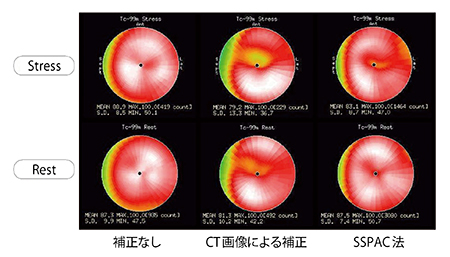 図3　SPECT/CT装置のCT画像を使った減弱補正とSSPAC法による減弱補正の比較