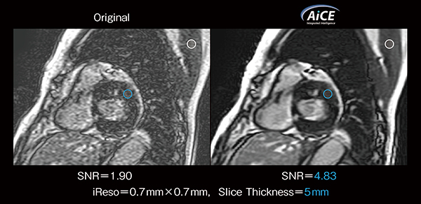 図1　肥大型心筋症におけるAiCE適用thin slice LGEのSNR向上効果 （画像ご提供：自治医科大学附属さいたま医療センター様）