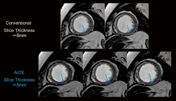 図2　拡張型心筋症におけるAiCE適用thin slice imagingの有用性 （画像ご提供：自治医科大学附属さいたま医療センター様）