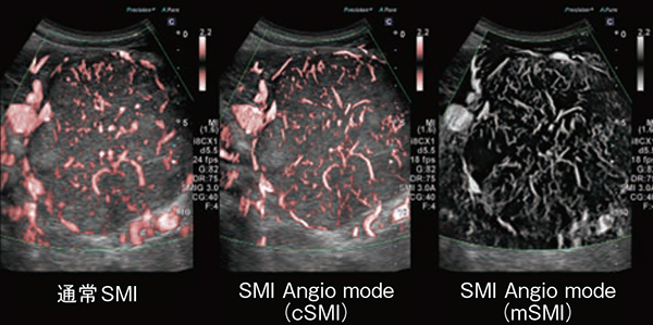 図4　膵神経内分泌腫瘍 グレードⅠ （左）通常のSMI，（中央）同腫瘍のSMI Angio modeをcSMIで撮像した画像，（右）同腫瘍のSMI Angio modeをmSMIで撮像した画像 （画像ご提供：飯田市立病院・岡庭信司先生）
