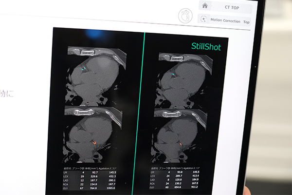 画像解析技術で心拍動による画像ブレを低減する「Body StillShot」と心電図非同期の石灰化スコア