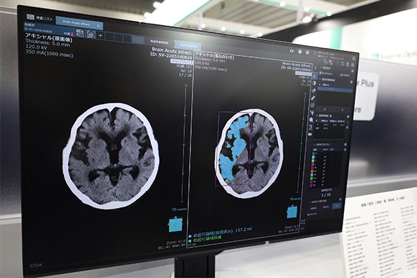データを自動転送して解析を行う「SYNAPSE VINCENT Core」（写真は頭部の低吸収域解析機能）