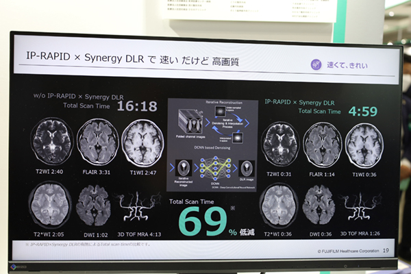 IP-RAPID×Synergy DLRで高速撮像かつ高画質を実現