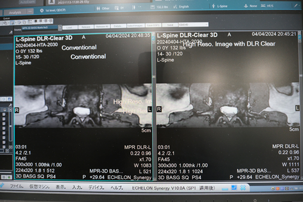 ノイズ除去技術「Synergy DLR」を一新し画像尖鋭度を向上