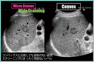 図2　C23RV/C23によるWide Scanningの画像（症例1：転移性肝がん）