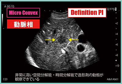 図3　C23RV/C23によるDefinition PIの動脈相の画像（症例1）