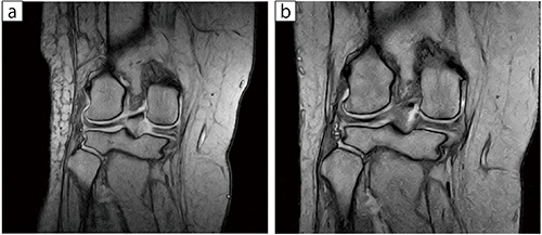 症例2：右膝内側半月板後根断裂（MMPRT）