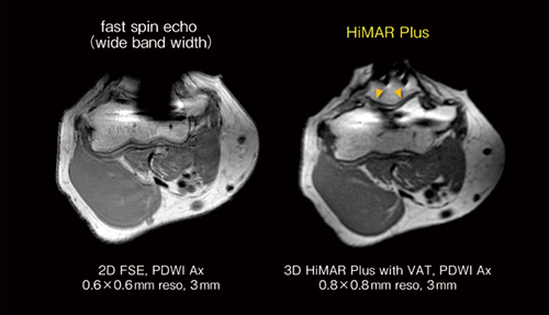 図7　肘関節の金属インプラントにおけるfast spin echo法とHiMAR Plusの画像比較 HiMAR Plus（右）の方が金属インプラント部分の磁化率アーチファクトが低減し，関節面（▼）の視認性が向上している。