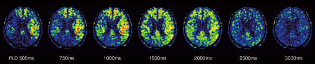 図8　Multiphase ASL 複数の異なるPLDの灌流画像により，血液到達の遅れをより正確に視覚化することが可能。