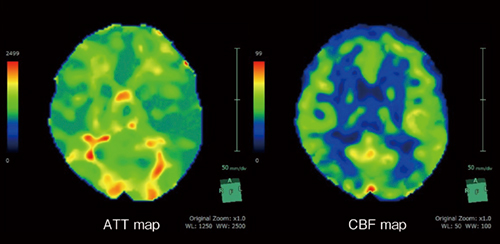 図9　SYNAPSE VINCENT Coreで解析されたATT mapとCBF map