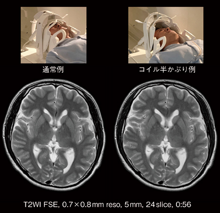 図1　頭頸部受信コイルの通常例と半かぶり例