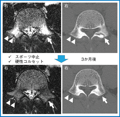 図3　保存治療の経過（骨癒合例） 14歳，男性，野球選手
