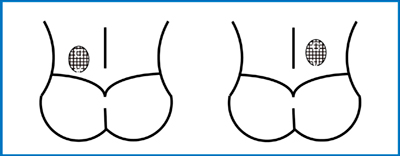 図2　発育期腰椎分離症の腰痛部位