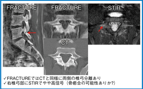 図1　L5 両側分離症（18歳，男性）