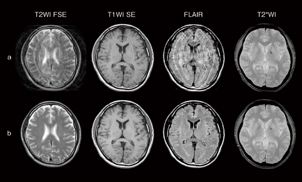 図2　体動アーチファクト画像（a）とVisual StillShotによる再構成画像（b） 体動アーチファクトが発生した画像（a）を撮像後，Visual StillShotで画像再構成をすることにより，体動アーチファクトを低減した画像（b）を生成することができる。