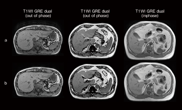 図3　体動アーチファクト画像（a）とNavigated StillShotによる再構成画像（b） 腹部の息止め不良例を想定した腹囲の異なるボランティア画像（a）を撮像後，Navigated StillShotで画像再構成をすることにより，体動アーチファクトを低減した画像（b）を生成することができる。