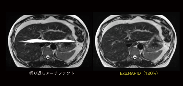 図4　Exp.RAPID画像再構成による折り返しアーチファクト低減効果 折り返しアーチファクト像（左）では，画像中央に皮下脂肪信号の偽像があるが， Exp.RAPIDを120％に設定した再構成画像（右）では，折り返しアーチファクトの偽像部分がなくなっていることがわかる。