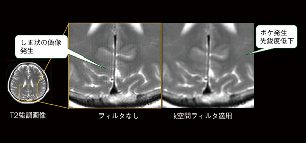 図5　トランケーションアーチファクトの発生とk空間フィルタによる画像ボケ 有限のデータで画像再構成を行う際に生じる信号の段差が原因で発生するトランケーションアーチファクトは，平行な明暗線の偽像として現れる。この偽像を軽減するためにトランケーションフィルタというk空間フィルタを使用すると画像先鋭度が低下する。