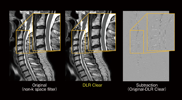 図6　DLR Clearによるトランケーションアーチファクト低減効果 頸椎のT2強調矢状断画像。DLR Clearを付加することにより，しま状のトランケーションアーチファクトが低減していることがわかる。OriginalとDLR Clearの差分画像ではしま状のアーチファクトが確認でき，DLR Clearによりトランケーションアーチファクト部分の信号が低減していることを示す。