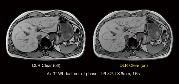 図7　DLR Clearによる画像先鋭度の向上 左右の画像とも同じピクセルサイズで撮像した腹部T1強調画像。DLR Clearを使用すると同じピクセルサイズで撮像しているにもかかわらず，画像先鋭度が向上していることがわかる。