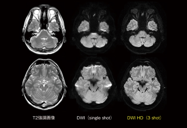 図9　DWI HDによる画像歪みの低減効果 DWI（single shot）では内耳や前頭洞付近に画像歪み（磁化率アーチアクト）が発生しているが，DWI HD（3 shot）では，画像ボケも軽減し，なおかつ画像歪みも低減していることがわかる。