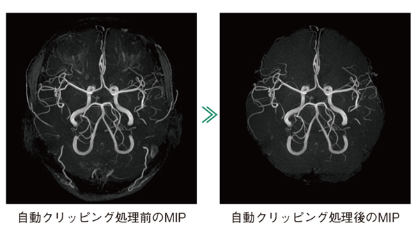 図7　AutoClipによる自動クリッピング処理前後のMIP MRA撮像終了後，自動で頭部MRAのクリッピングを実行する。自動クリッピングは，頭部の特徴量に基づいて抽出範囲を識別する。自動クリッピング処理後の画像に対し，追加のクリッピングを行うことも可能である。
