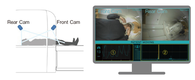 図9　Synergy Visionと被検者監視モニタ ガントリ内の頭尾方向に2つのカメラを搭載しており，被検者を近距離から監視することができる。カメラ映像から検査中の被検者の動きの大きさを推定し，(1) 呼吸動波形と(2) 体動波形が表示され，MRI検査中に被検者がガントリからはい出してくるような大きな動き，咳やくしゃみのような小さな動きを検出し，体動発生を操作者に通知する。