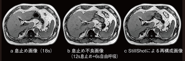 図10　息止め画像と息止め不良画像にStillShot再構成した画像 息止め不良により体動アーチファクトが発生した画像（b）を撮像後，StillShotにて画像再構成することにより，体動アーチファクトを低減した画像（c）を生成することできる。息止め画像（a）とStillShotによる再構成画像（c）に大きな差異がないことがわかる。