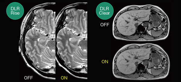 図12　DLR RiseとDLR Clear DLR Rise（左）は，AI技術を活用して開発したノイズ除去技術である。DLR Clear（右）は，AI技術を活用して開発したトランケーションアーチファクト低減と画像鮮鋭度の向上が期待できる技術である。