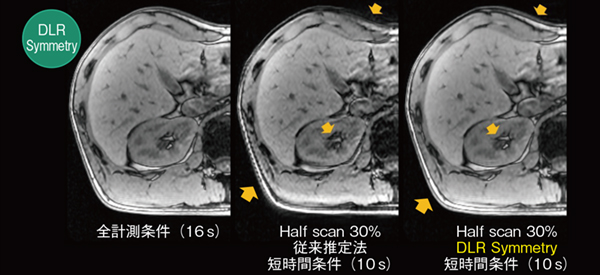 図13　DLR Symmetry ハーフスキャン30%で撮像時間を短縮した従来推定法はアーチファクトが散見されているが，DLR Symmetryでは全計測条件と同等の画質が得られている。