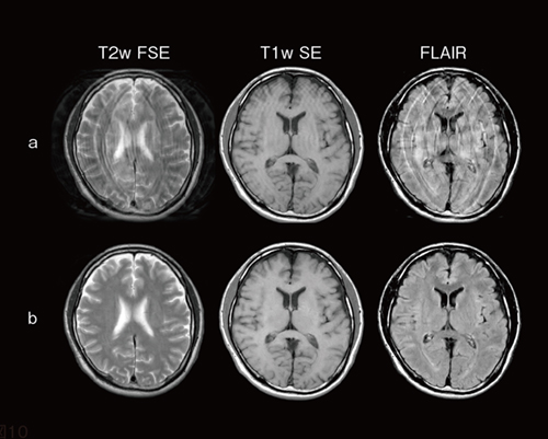 図2　体動アーチファクト画像（a）とStillShotによる再構成画像（b） 体動アーチファクトが発生した画像（a）を撮像後，StillShotで画像再構成をすることにより，体動アーチファクトを低減した画像（b）を生成することができる。