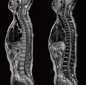 T1WI，DIXON In/Out，2 station scan time：1:39/station スライス厚：4mm マトリックス：288×224