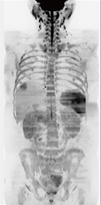 Body DWI（b＝800），4station scan time：2:38/station スライス厚：5.5mm マトリックス：108×128