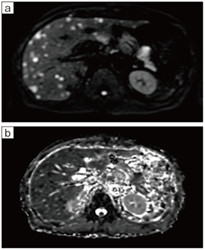 a：DWI（b＝800）　b：ADC scan time：2:38，スライス厚：6mm， マトリックス：108×124