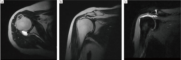 a：T2WI アキシャル，2D DE FSE，TR/TE＝3805/100，スライス厚：4.5ｍｍ，FOV：180，マトリックス：256×192，撮像時間：4:08 b：T2WI コロナル，2D DE FSE，TR/TE＝3805/100，スライス厚：4.5ｍｍ，FOV：180，マトリックス：256×192，撮像時間：4:08 c：STIR コロナル，2D DE FSE，TR/TE＝3500/25，スライス厚：4.5ｍｍ，FOV：180，マトリックス：192×160，撮像時間：4:58